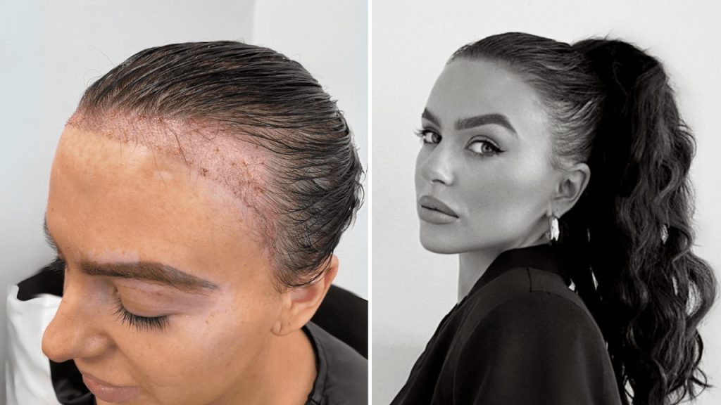 Affordable & Effective Hair Transplant Birmingham Options