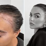 Affordable & Effective Hair Transplant Birmingham Options